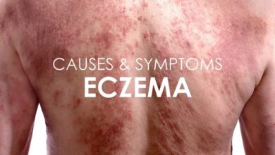 Eczema dermatitis atopic remedies symptoms redness patchy characterized