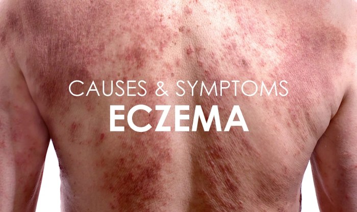 Eczema dermatitis atopic remedies symptoms redness patchy characterized