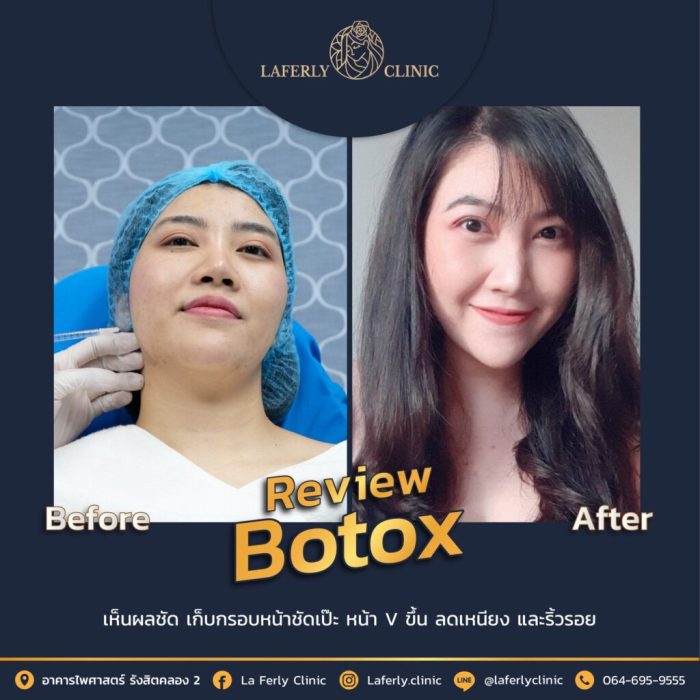 Botox boleh dilakukan di umur berapa ini jawaban dokter